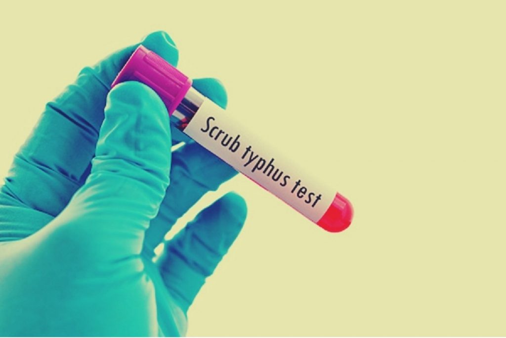 Cases Of Scrub Typhus Found In Uttar Pradesh