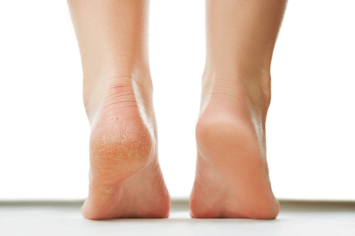 What causes cracked heels? Know prevention tips and home remedies to get  smooth feet – India TV