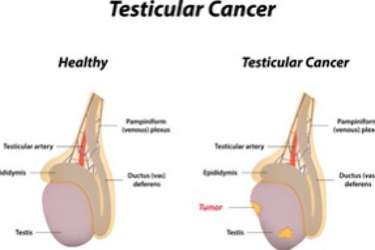 Why young men must be aware of testicular cancer