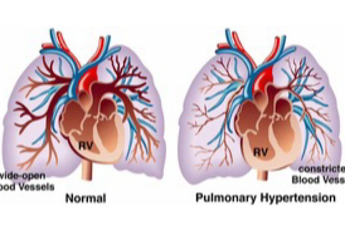 Indian scientists find 4 previously overlooked genes to fight deadly  lung condition