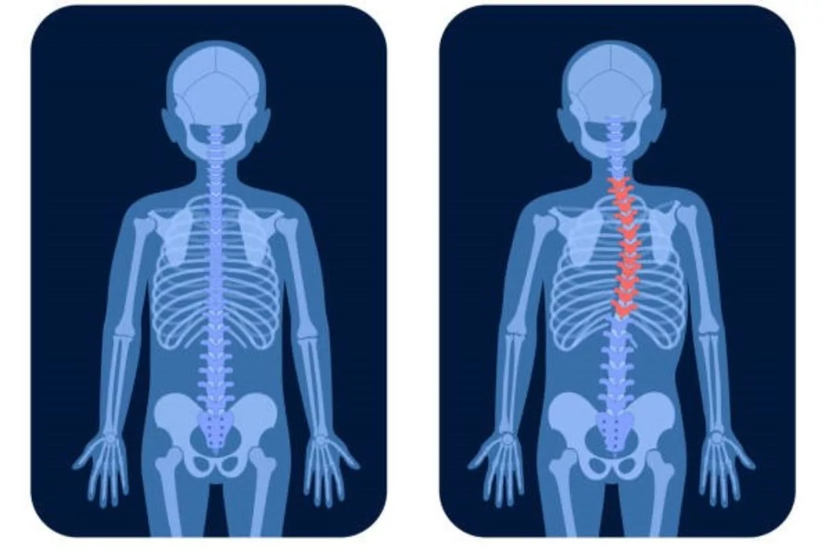 Initiative to treat spinal deformities